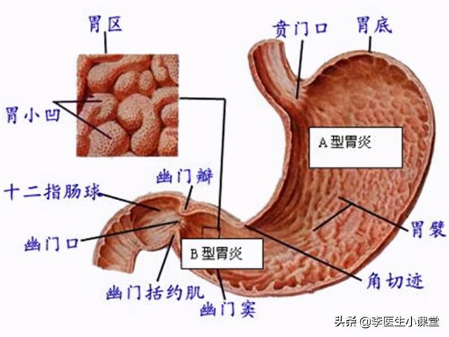 浅表性胃炎的症状 浅表性胃炎的症状