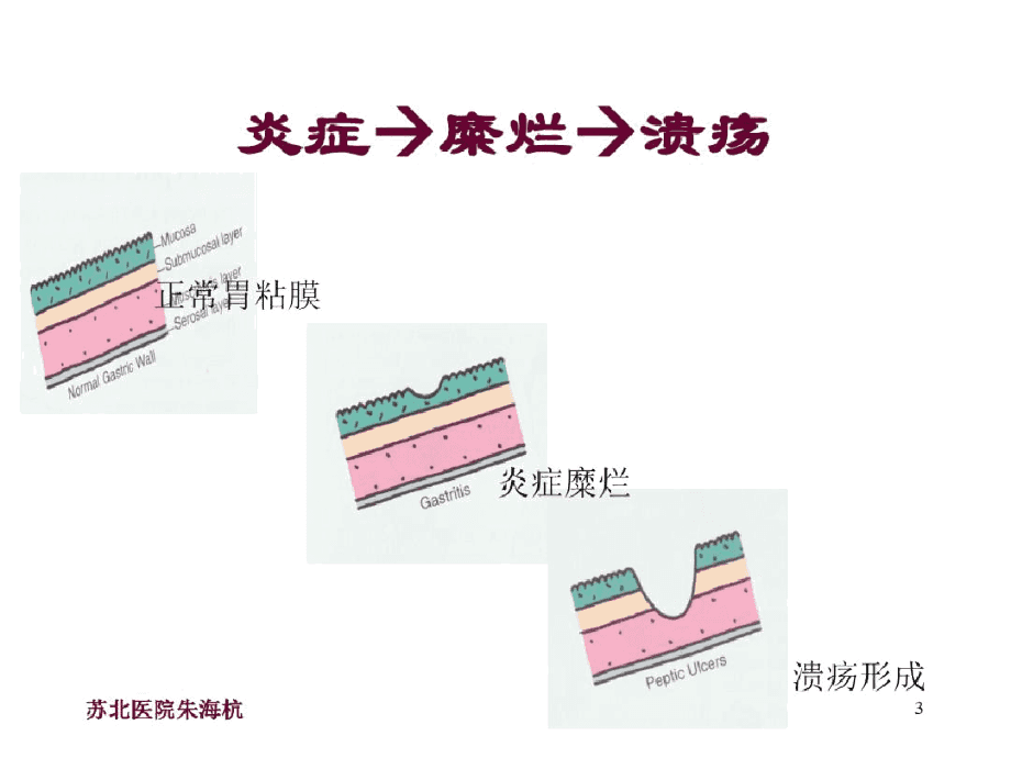 黑便一定是出血吗,消化道溃疡