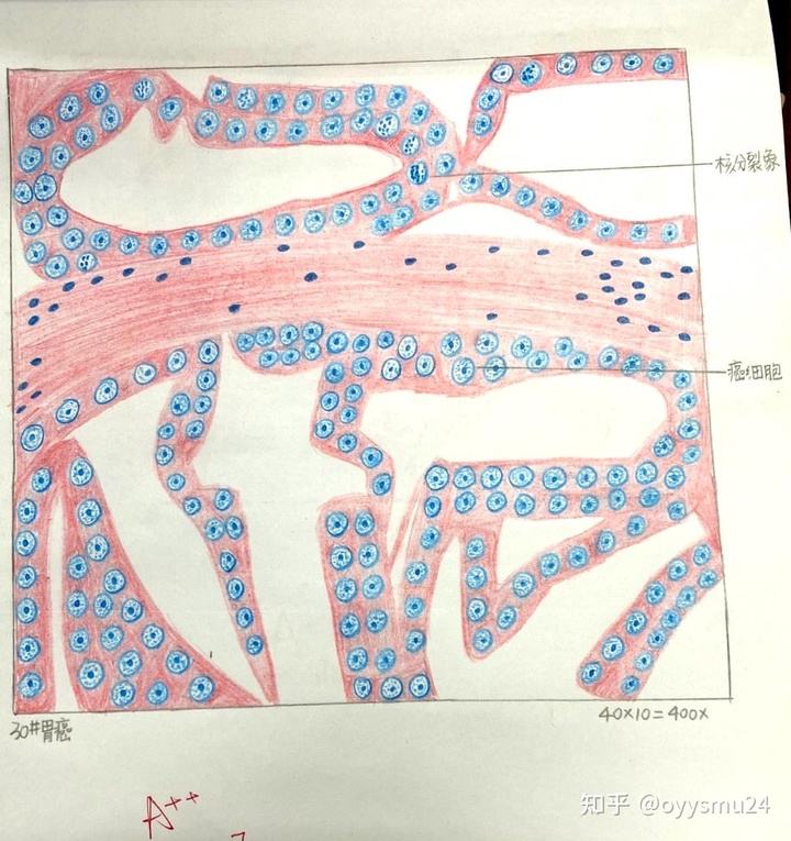 肠伤寒肠伤寒病理特点