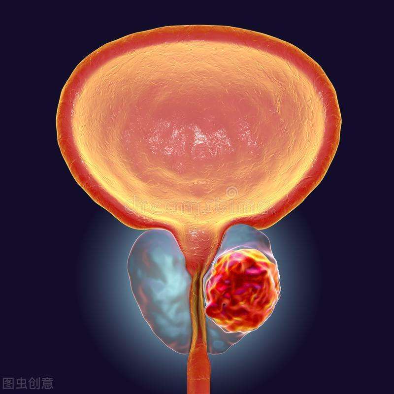 前列腺钙化灶怎么消除,前列腺钙化灶