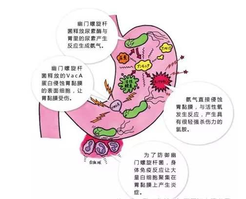 有幽门螺杆菌是什么症状 有幽门螺杆菌是什么症状