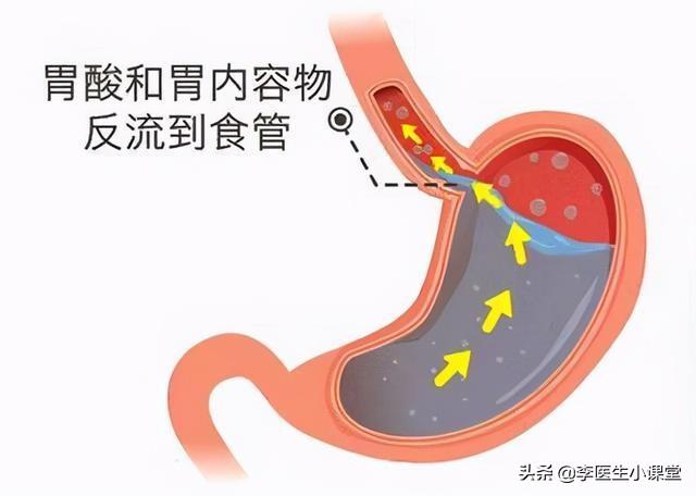 烧心吃什么药 烧心吃什么药