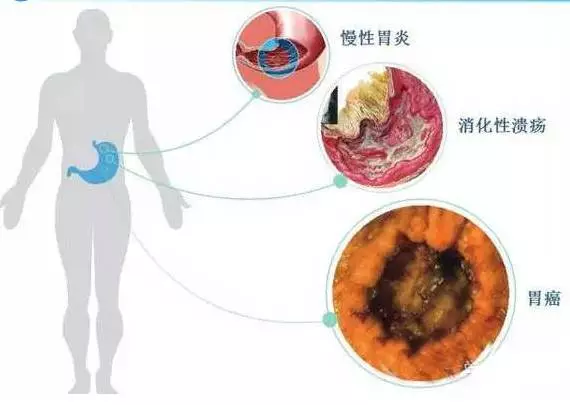 关于幽门螺旋杆菌的症状会自愈吗的信息