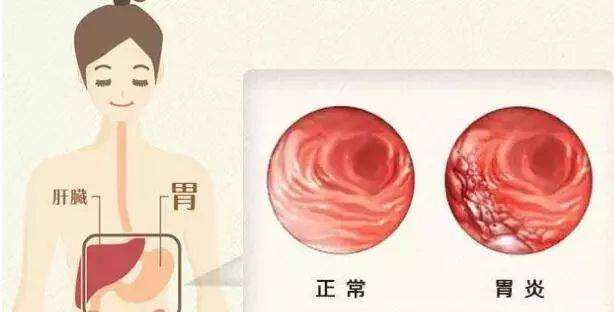 急性单纯性胃炎急性胃炎绞痛怎么处理