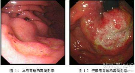 胃溃疡治疗年轻人最好不要做胃镜检查