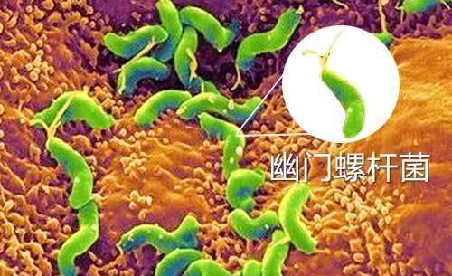 幽门杆菌是什么幽门最好自愈方法