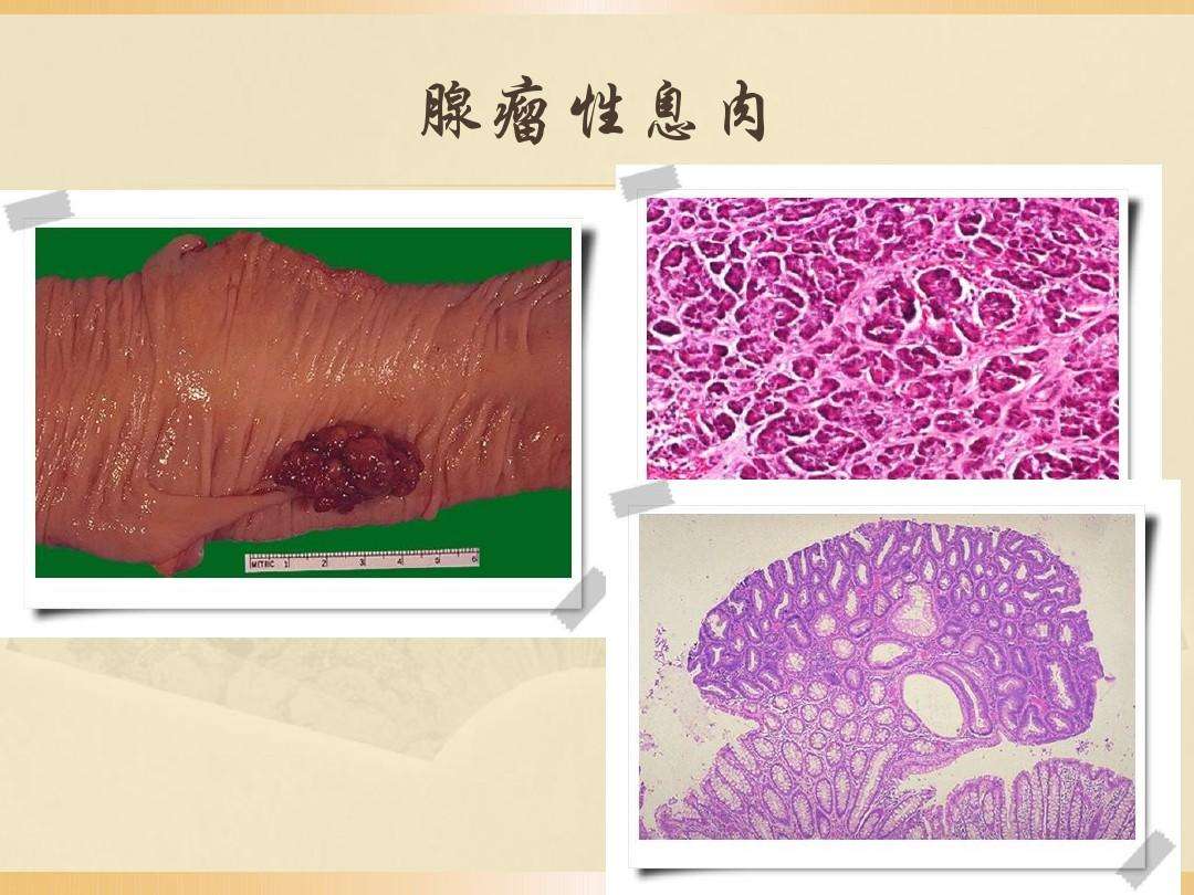 直肠息肉直肠息肉的早期症状
