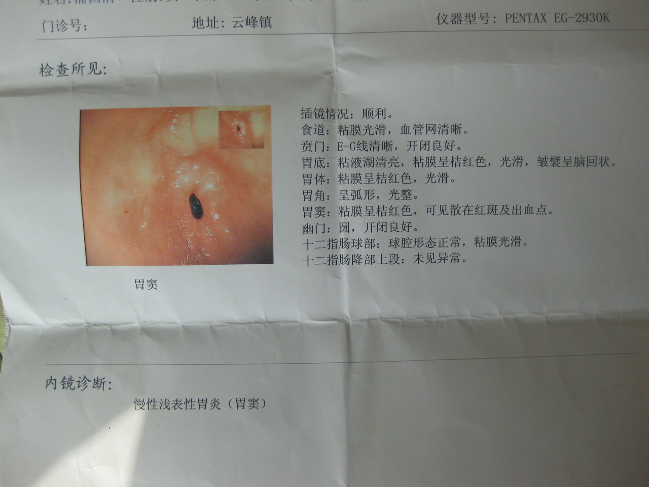 慢性胃窦炎,慢性胃窦炎的鉴别诊断