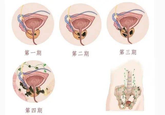 前列腺多发钙化灶是什么意思前列腺钙化灶是啥意思