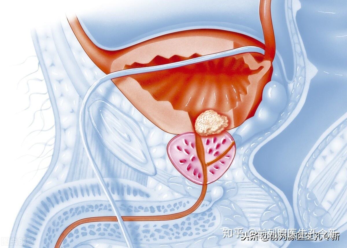 前列腺多发钙化灶是什么意思前列腺钙化灶是啥意思