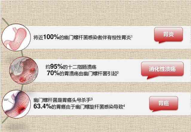 接吻100%会传染幽门螺旋杆菌吗螺旋幽门杆菌阳性代表什么