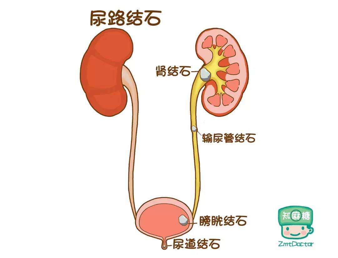 肾结石最快自愈方法,肾结石