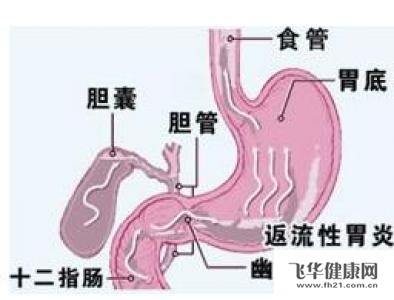胆汁返流,胆汁反流性胃炎