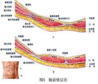 白线疝白线疝可以自愈吗