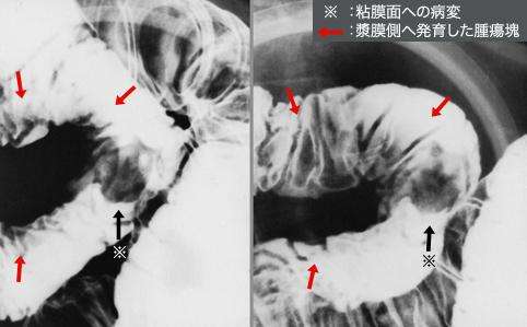 小肠癌小肠癌可怕吗