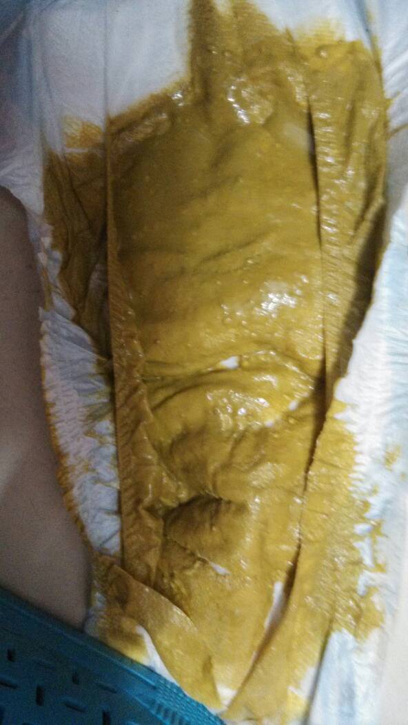 肠胃老是咕噜响还拉稀可以自愈吗肠胃不好经常拉肚子怎么调理