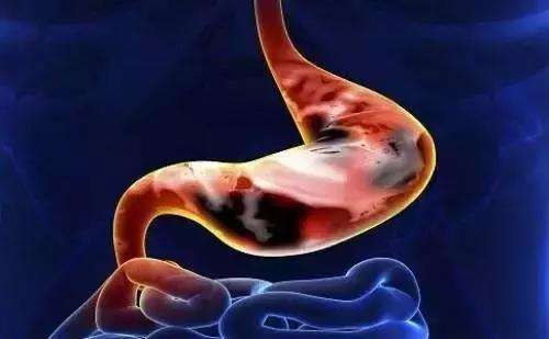 慢性胃炎有哪些症状萎缩胃炎一般能活多久