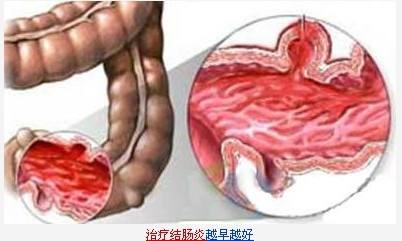 直肠炎直肠炎怎么治疗快速有效
