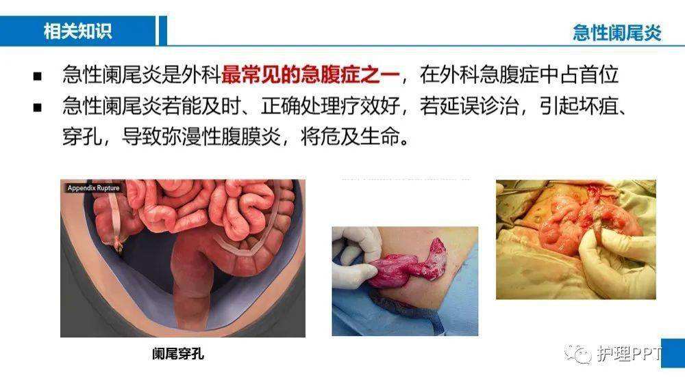 包含急性阑尾炎是怎么引起的的词条