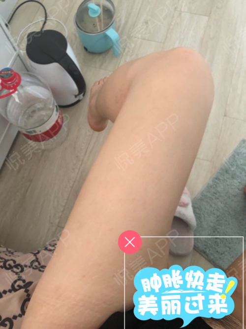 腿部吸脂减肥价格,抽脂肪20斤一般多少钱