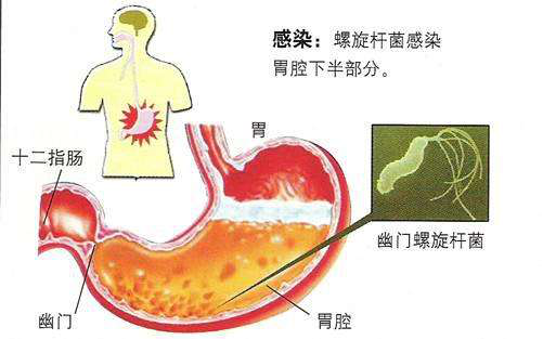 幽门螺旋杆菌怎么筛查,幽门螺旋杆菌怎么得上的