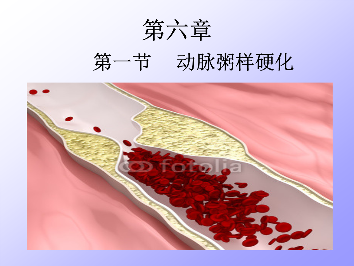 动脉硬化指数65高吗,动脉粥样硬化指数