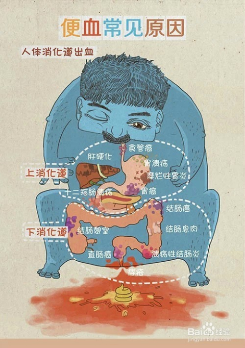 里急后重里急后重怎么缓解