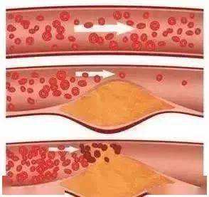 动脉硬化的治疗动脉硬化的治疗和预防