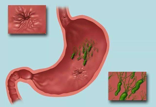 幽门螺旋杆菌的正常值范围DOB,幽门螺旋杆菌的正常值范围auml