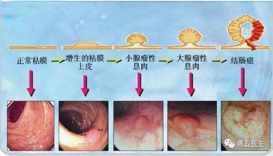 肠息肉症状及表现,肠息肉