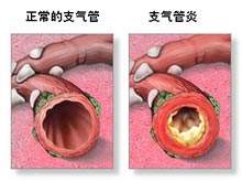 气管炎都有哪些症状,气管炎