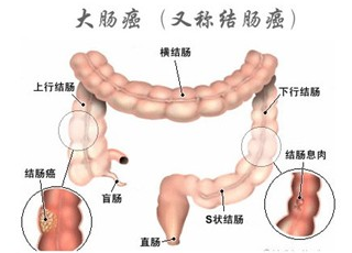 大肠癌的早期能治愈吗大肠癌的早期症状