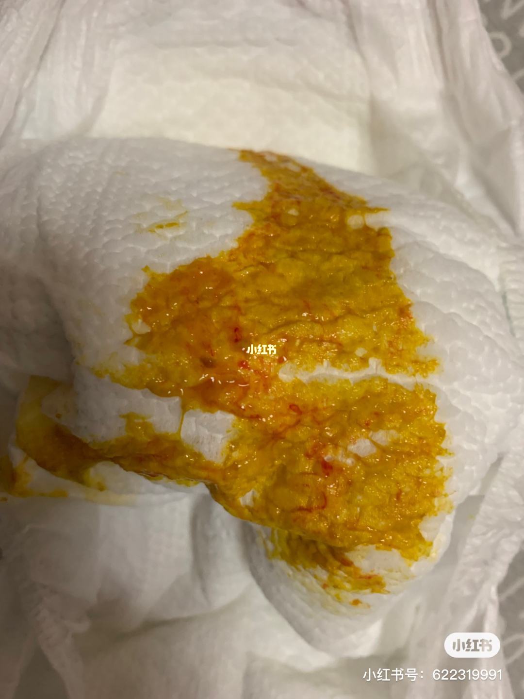 大便带血丝,便中带血是什么原因引起的