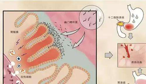 幽门螺旋杆菌的筛查方法幽门螺旋杆菌的筛查方法是