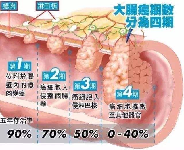 结肠癌早期的症状有哪些,结肠癌早期的症状