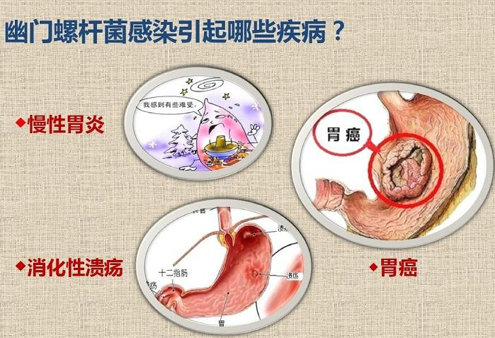 为什么会感染幽门螺旋杆菌阳性为什么会得幽门螺旋杆菌阳性