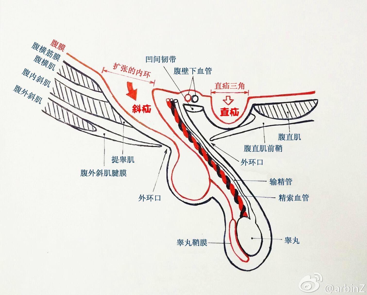 腹股沟疝气最简单的消除方法,腹股沟