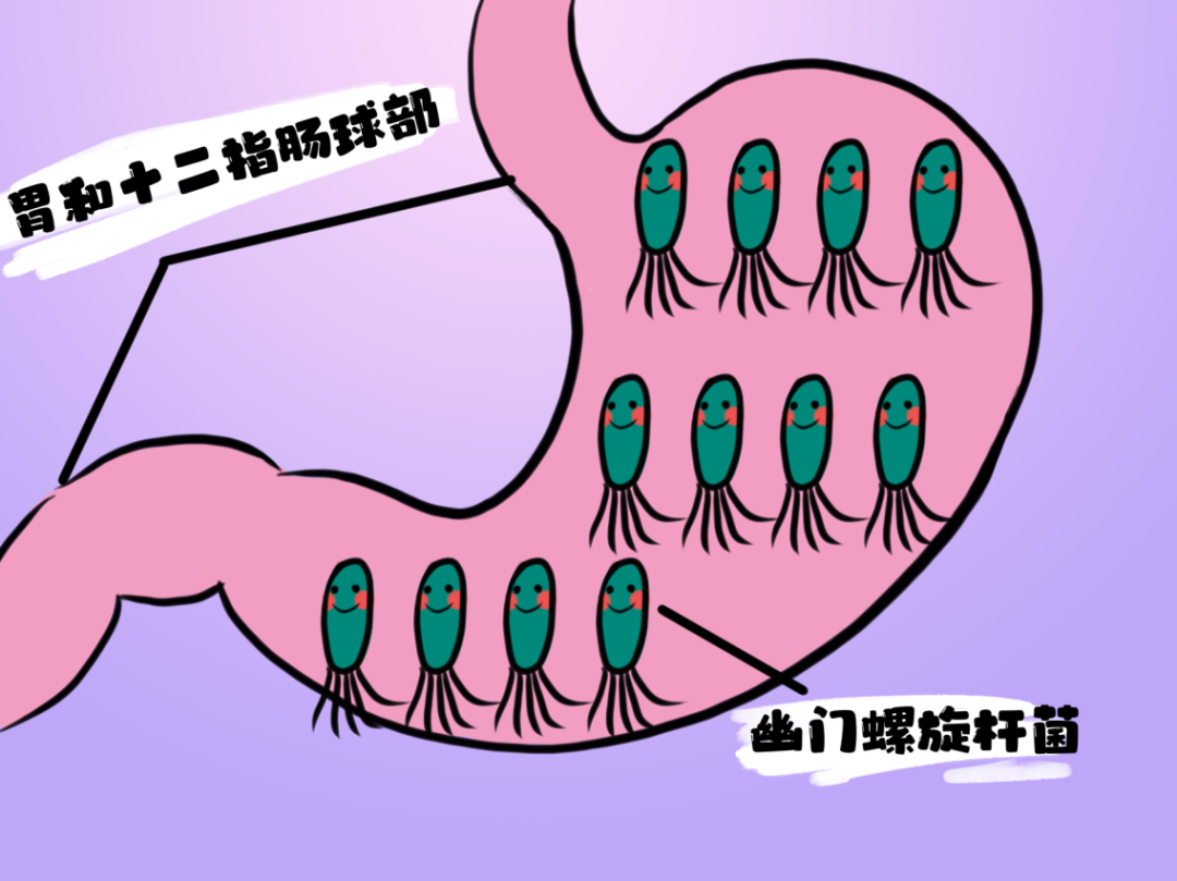 有幽门螺杆菌是什么样的症状幽门螺杆菌是什么样的症状