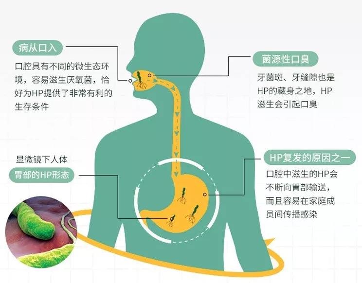 幽门螺旋杆菌阳性可以自愈吗幽门螺旋杆菌阳性有必要治疗吗