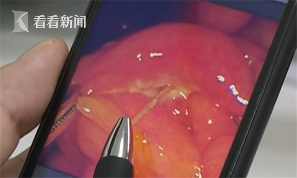 肠子疼,肠子疼吃什么药