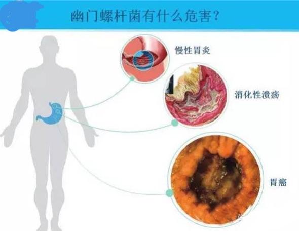 幽门螺旋杆菌阳性能彻底治好吗,幽门螺旋杆菌阳性能彻底治好吗吃什么药