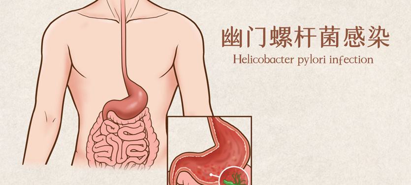 幽门螺杆菌一般怎么感染的幽门螺杆菌怎么感染的怎么造成的