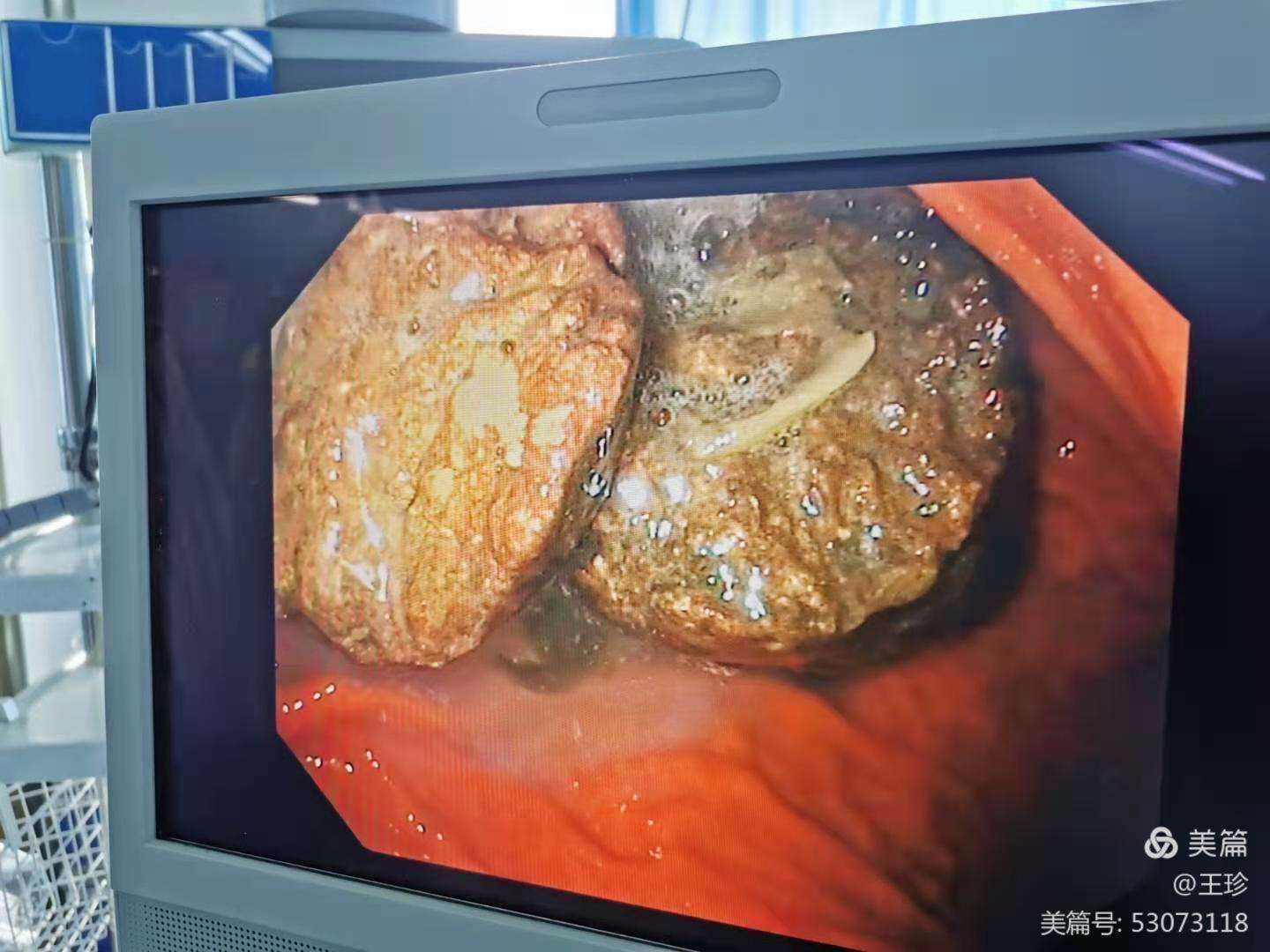 十二指肠癌,十二指肠癌的早期症状