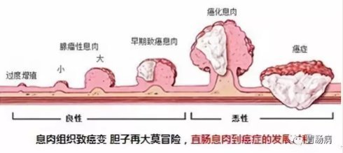 直肠息肉怎么治疗最好直肠息肉