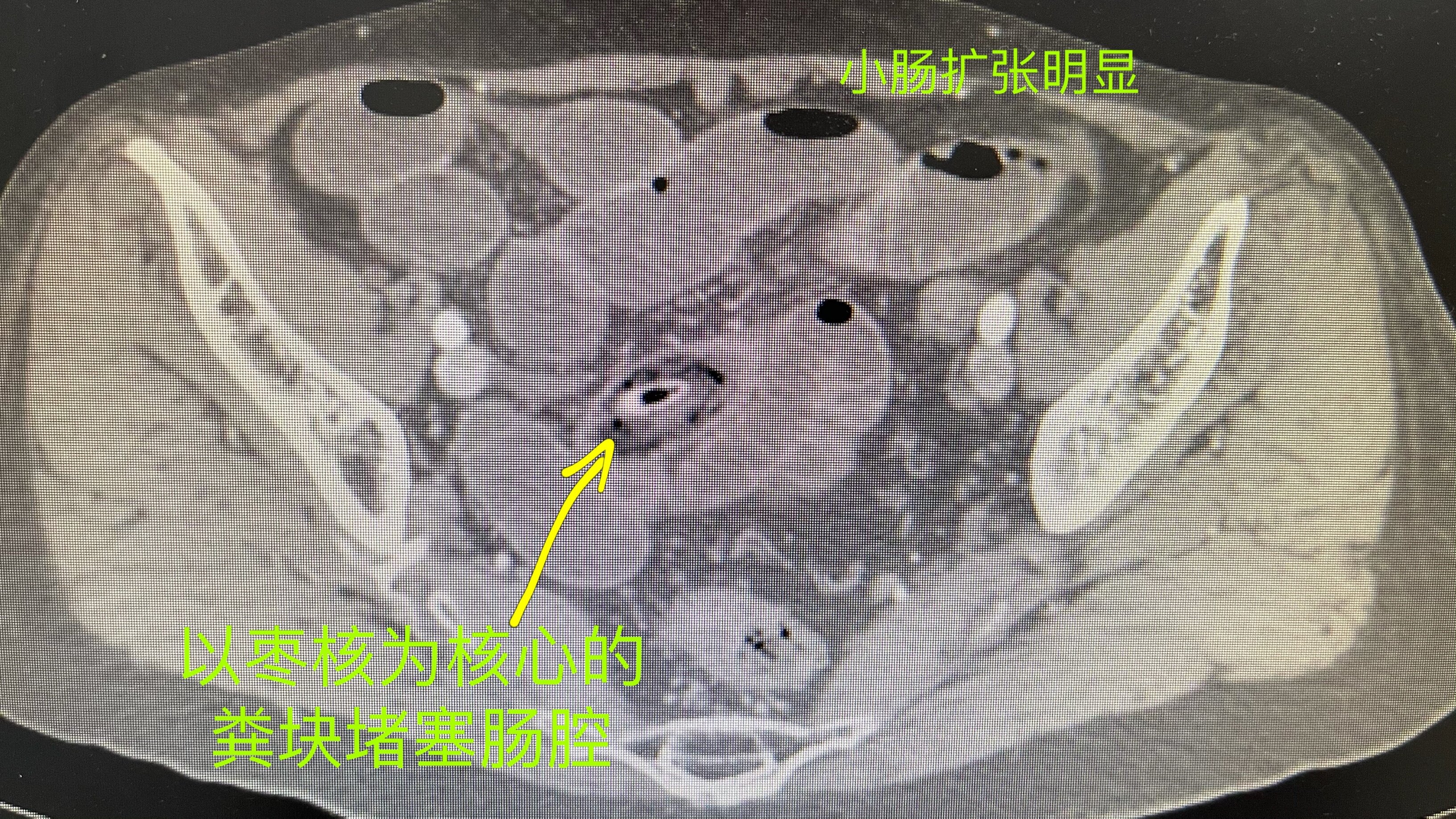 肠穿孔肠穿孔十个漏九个死