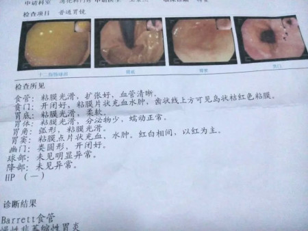 慢性非萎缩性胃炎是什么意思,慢性萎缩性胃炎吃什么药可以根治