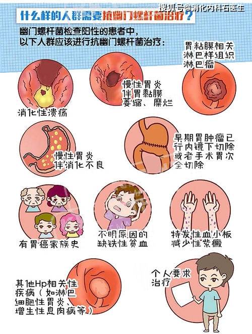 胃螺旋杆菌阳性是什么意思胃螺旋杆菌